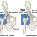 Hip Dysplasia