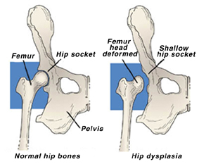 Hip Dysplasia